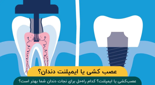 عصب-کشی-یا-ایمپلنت-دندان